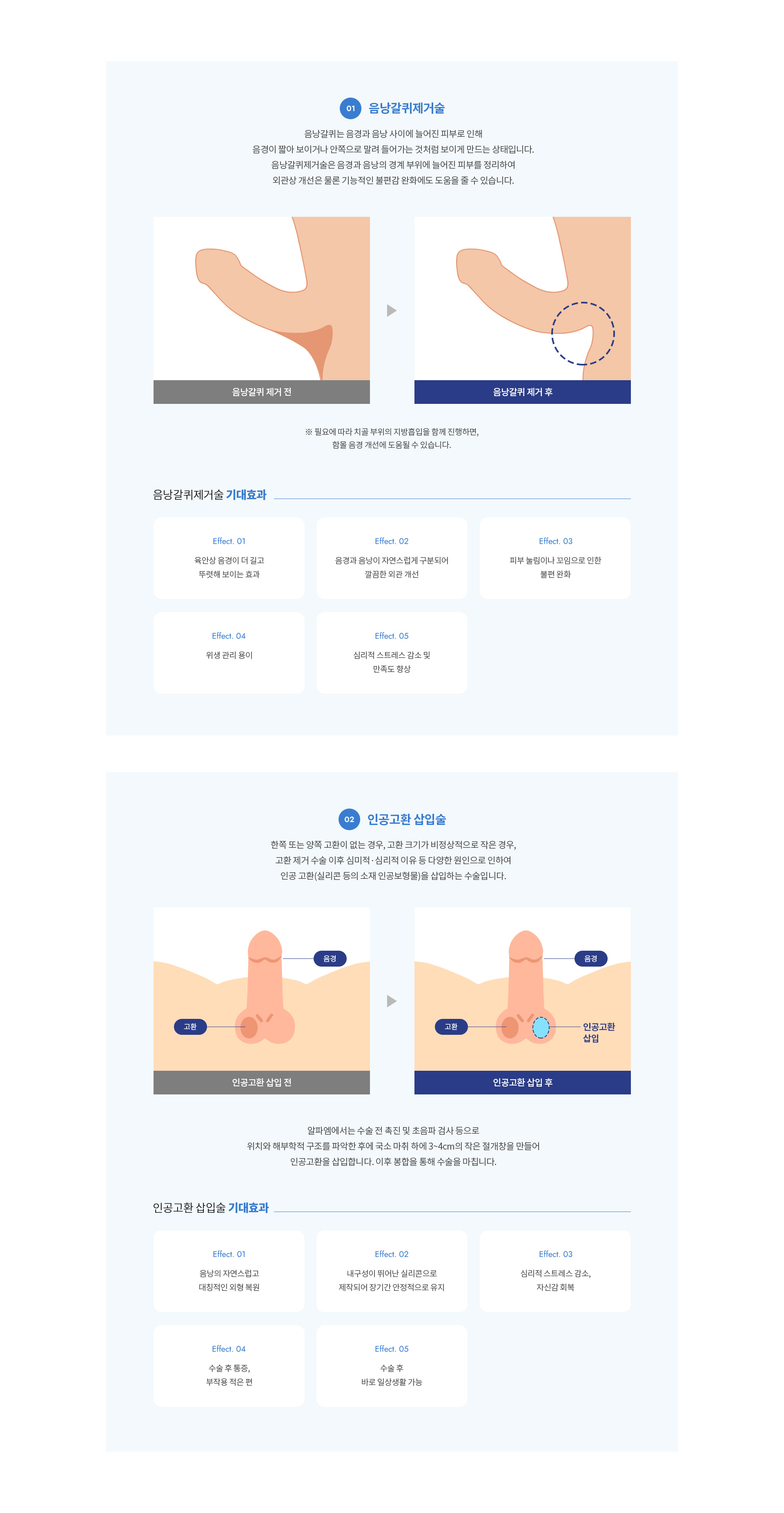 남성필러확대수술 07