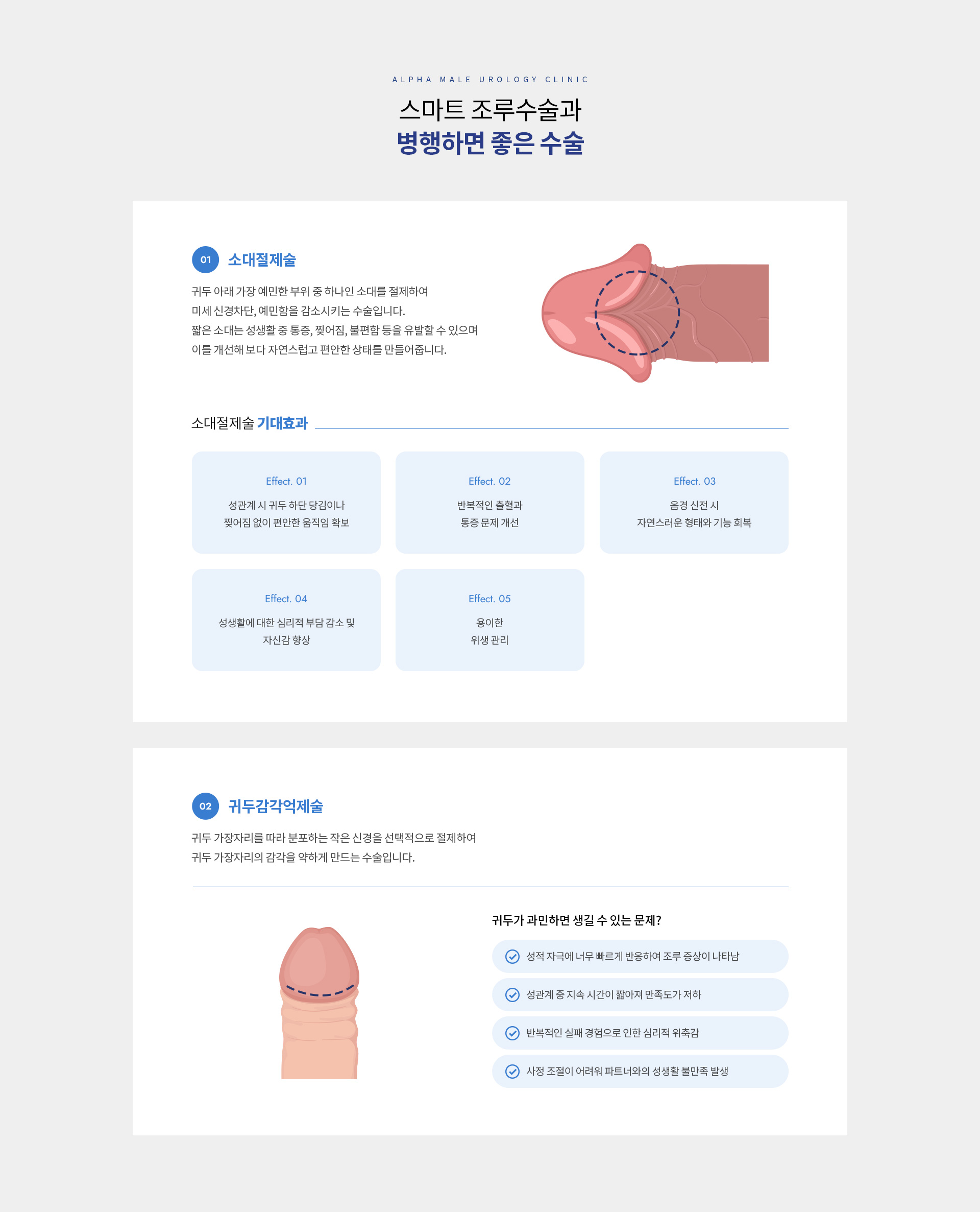 스마트조루수술 07