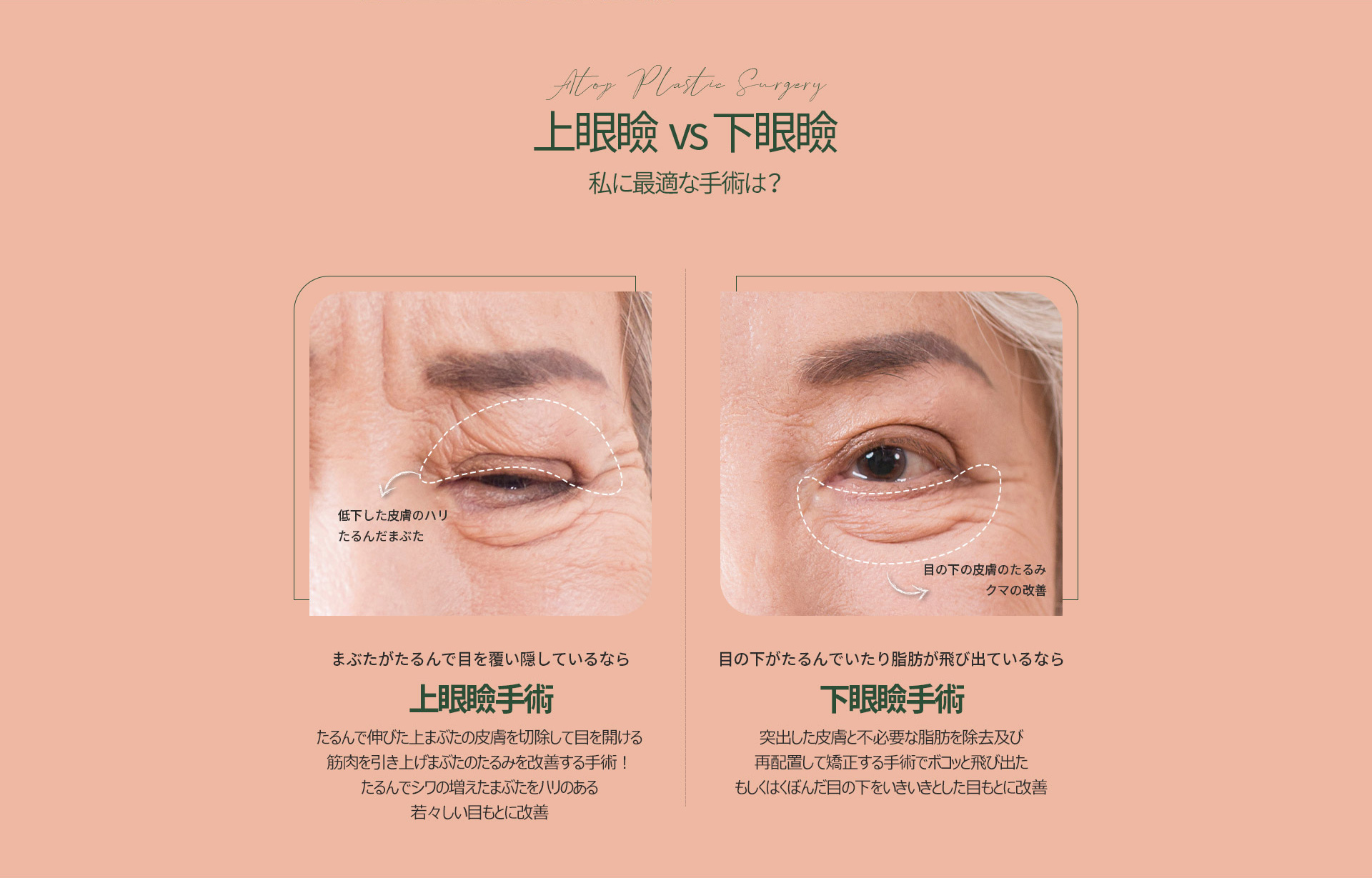 중년눈성형
