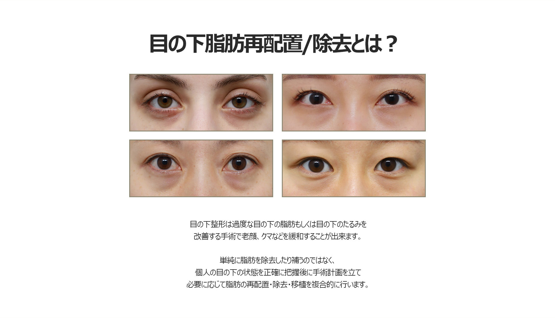 눈밑지방재배치/제거