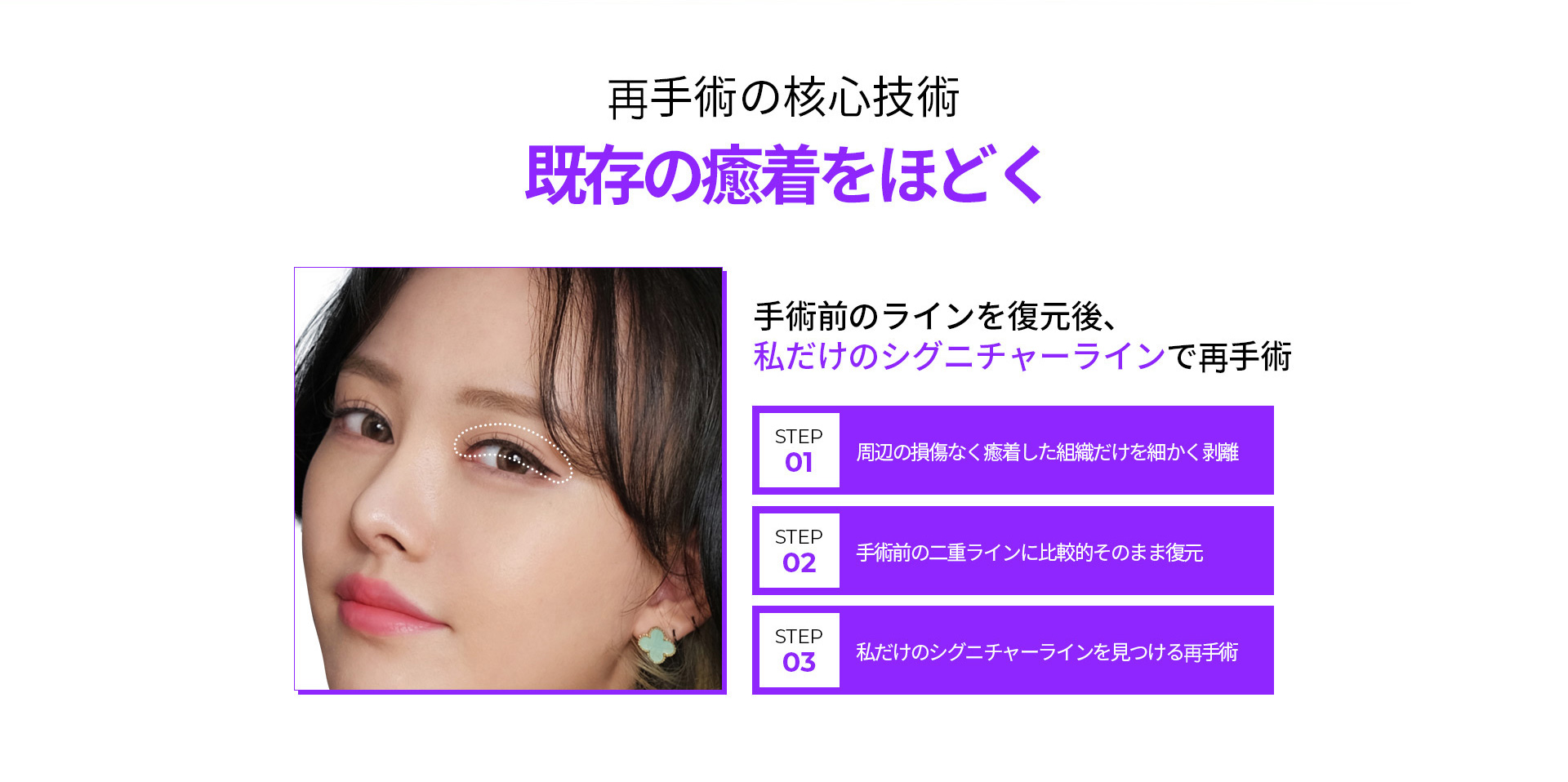 눈재수술