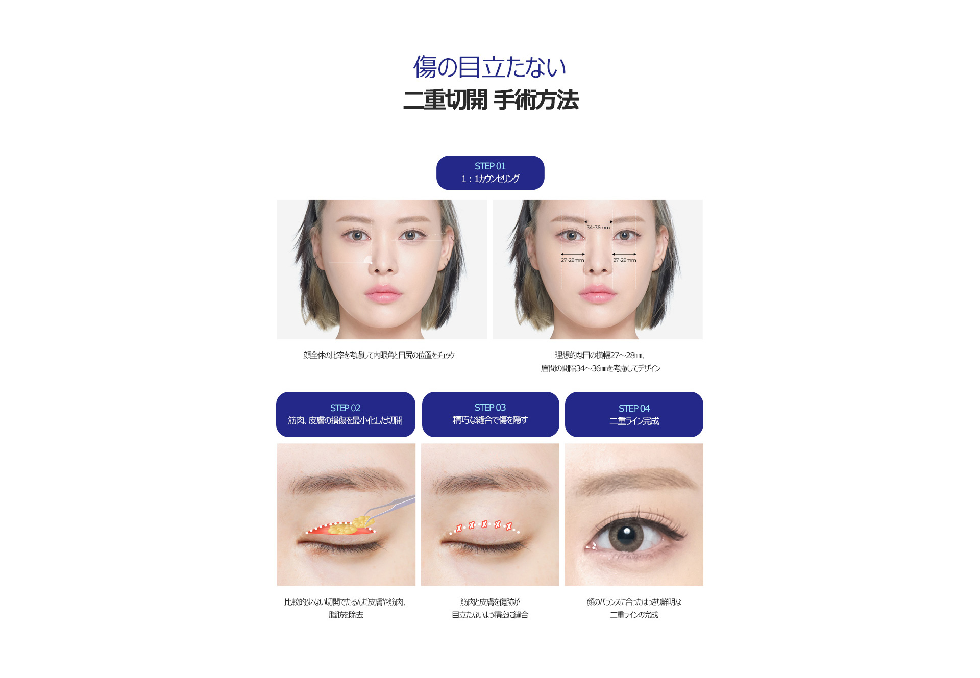 히든스카절개눈성형