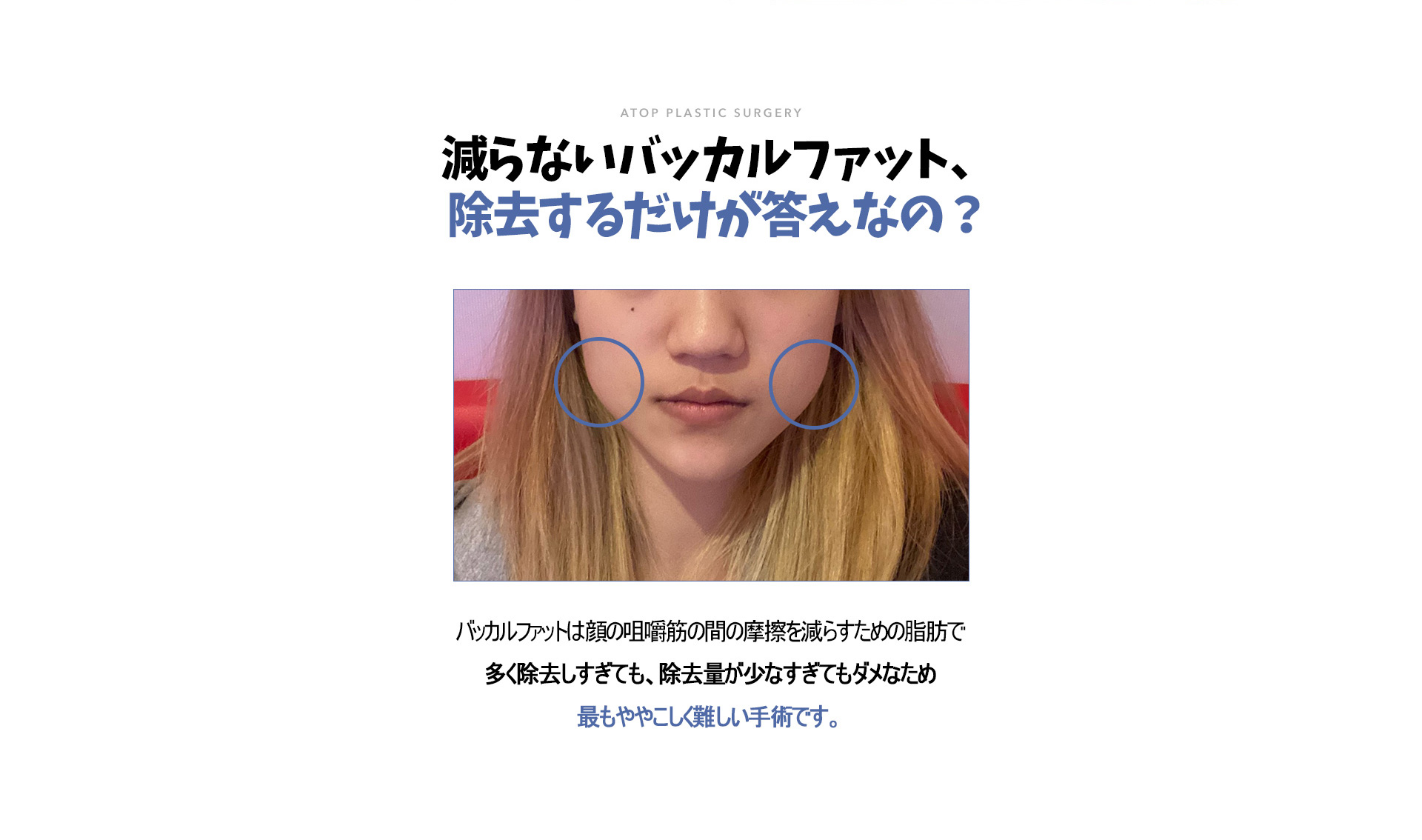 심부볼 지방 재배치