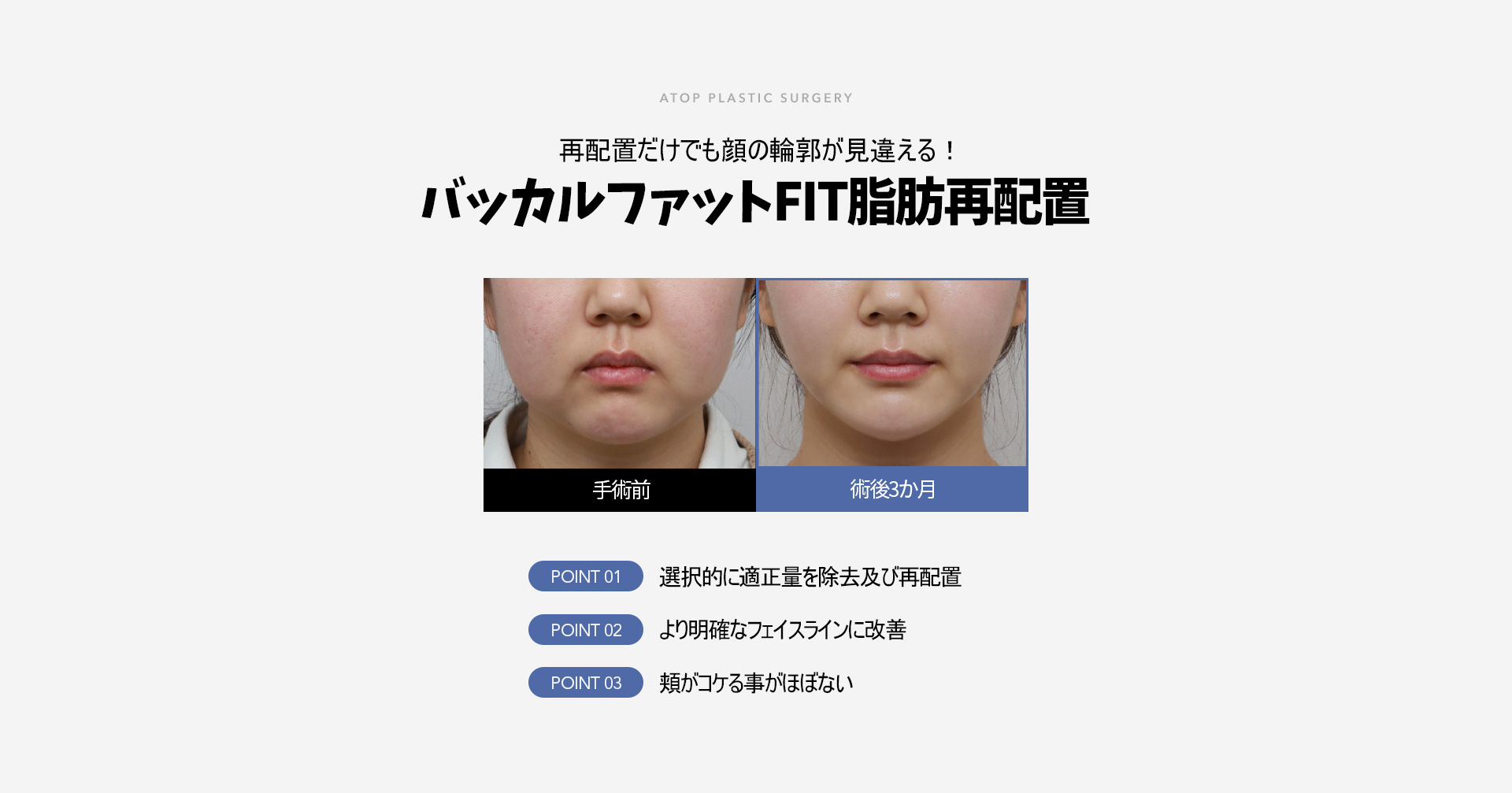 심부볼 지방 재배치