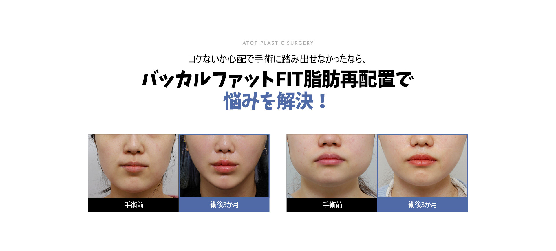 심부볼 지방 재배치