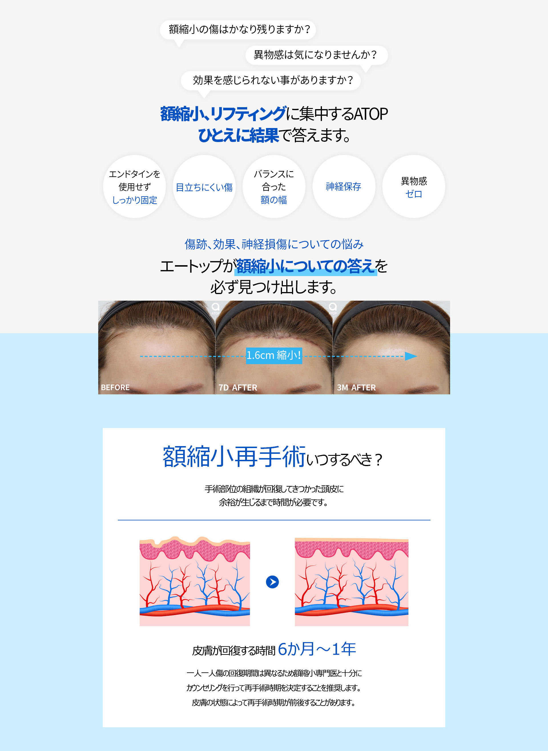 이마축소 재수술