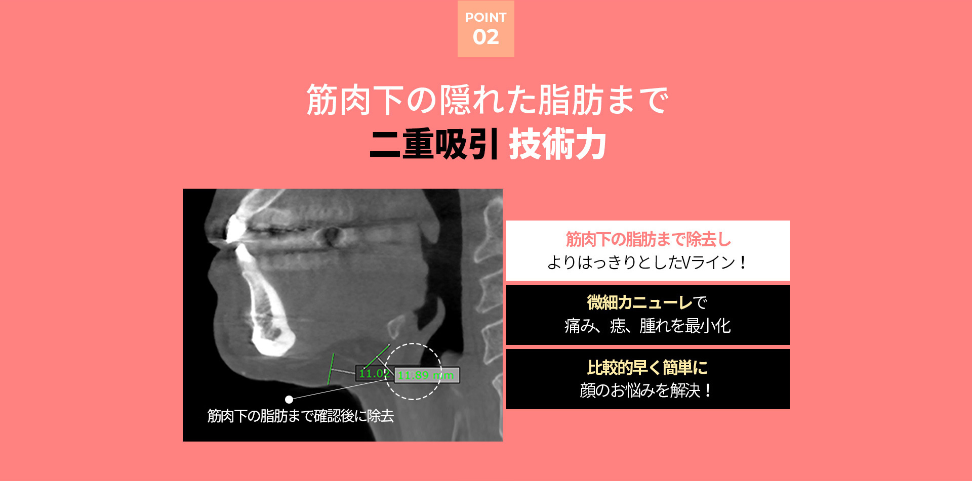 이중턱착붙리프팅