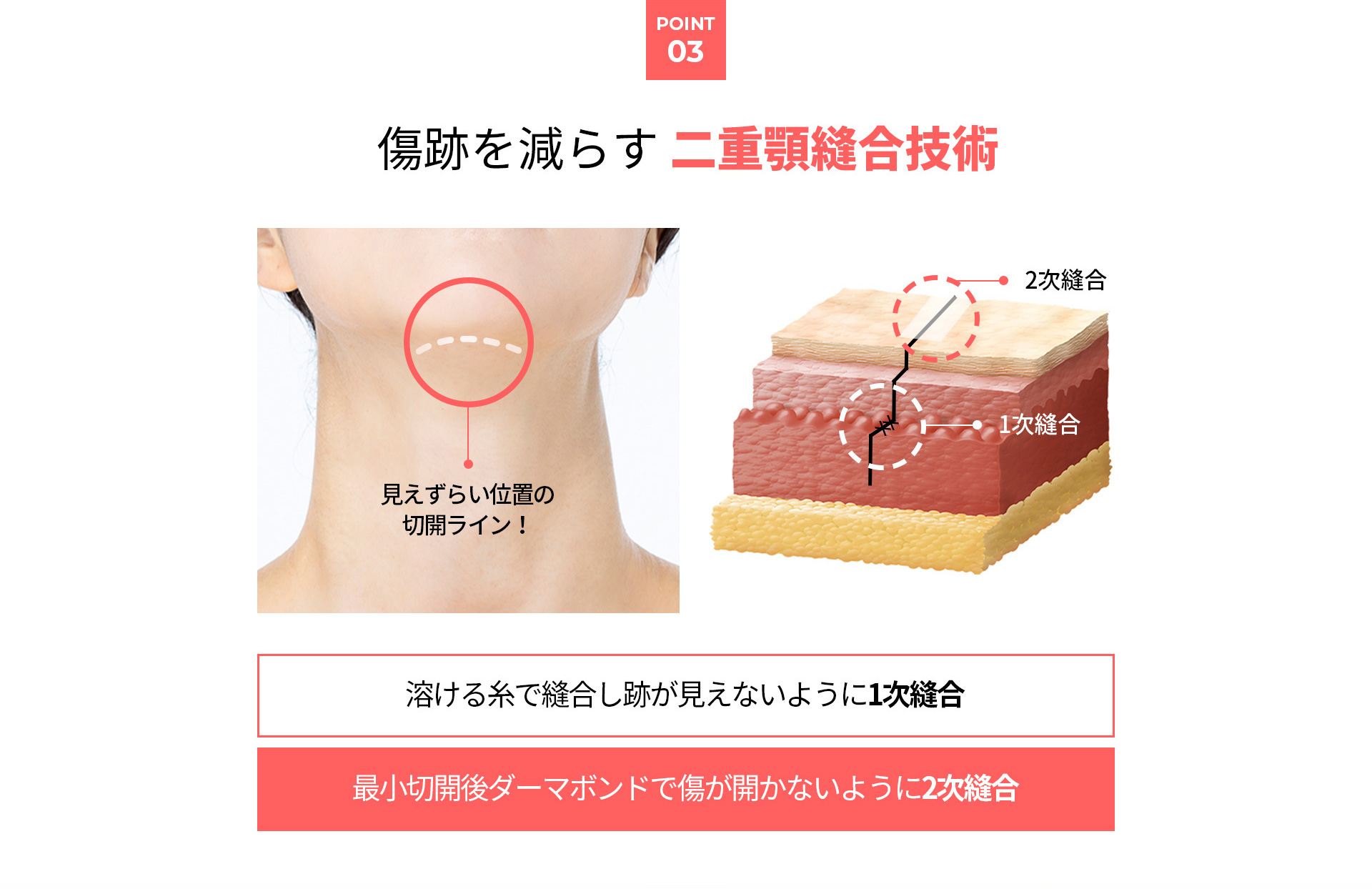 이중턱착붙리프팅