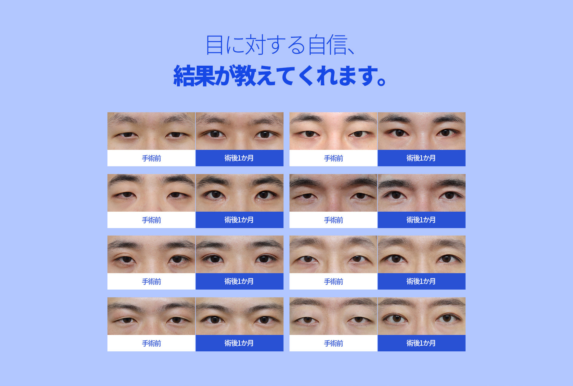 슬림라인 눈성형