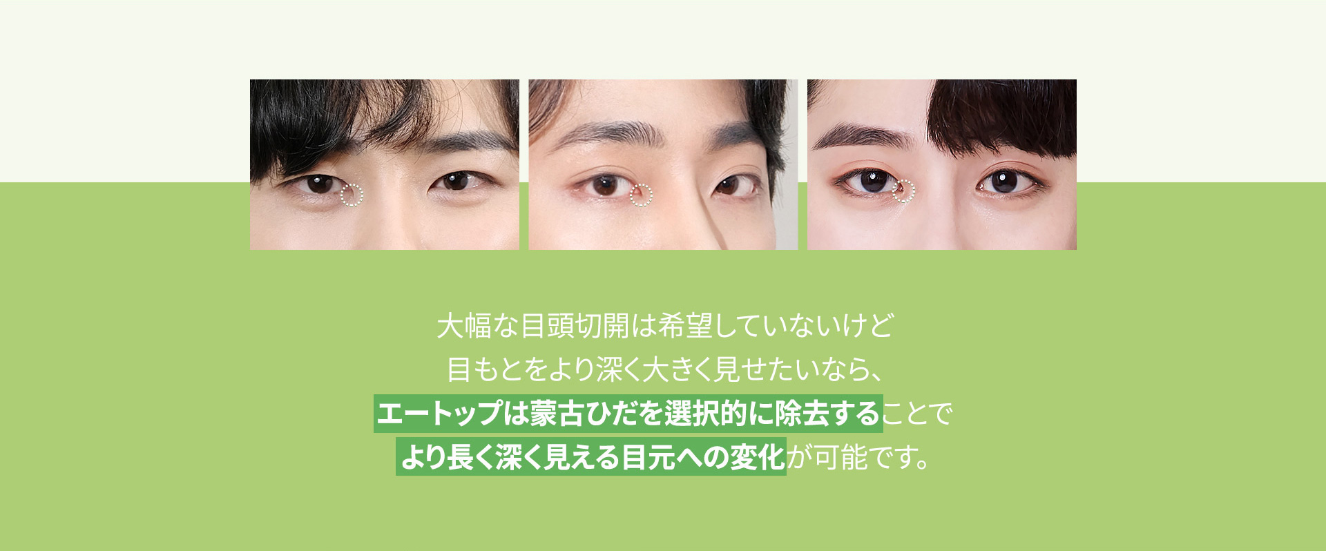남자 트임성형