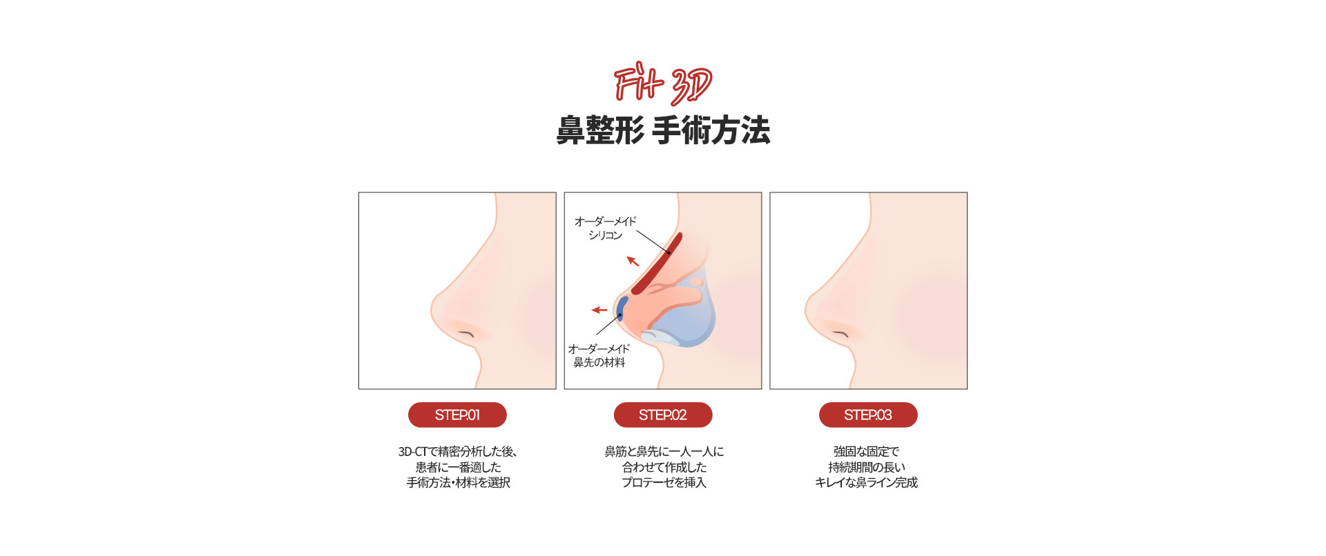 FIT 3D 코성형04