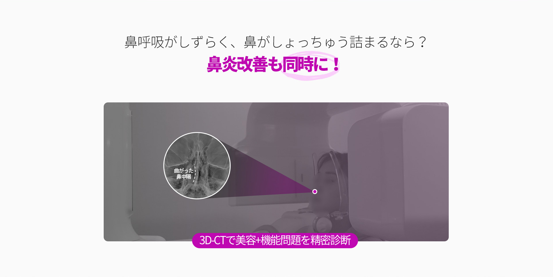 콧볼축소