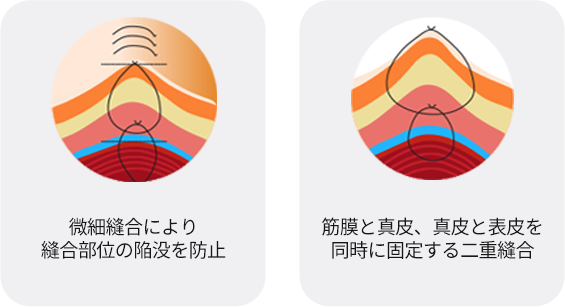 입술축소수술